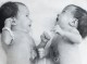 Как живут сиамские близнецы Таня и Аня Коркины спустя 30 лет после разъединения?
