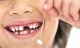 Почему выпадают молочные зубы?