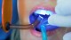 Зубные пломбы станут вечными благодаря новому материалу